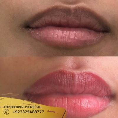 before after of smoker lips in Islamabad