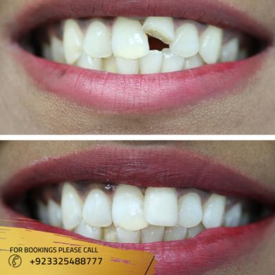 before after of teeth fracture treatment in Islamabad