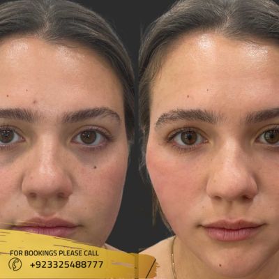 before after of thread lift in Islamabad