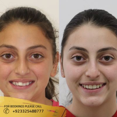 images of dental braces in Islamabad