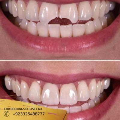 images of dental implant in Islamabad