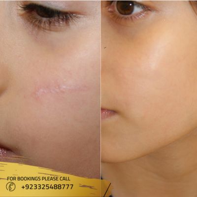 images of laser scar removal in Islamabad