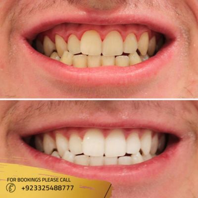 images of laser teeth whitening in Islamabad (1)