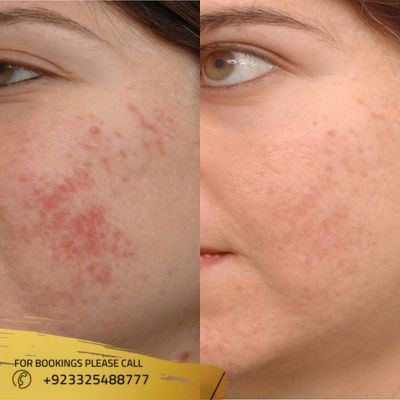 images of microdermabrasion treatment in Islamabad