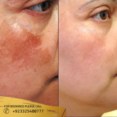 images of pigmentation treatment in Islamabad
