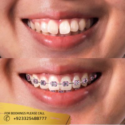 results of dental braces in Islamabad