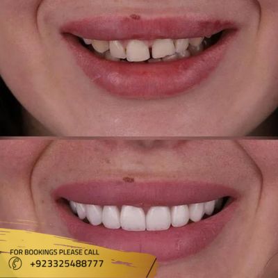 results of dental crown in Islamabad