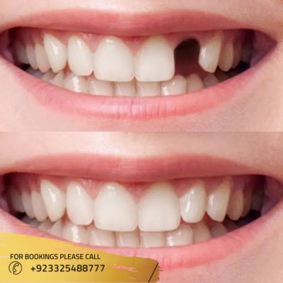 results of dental implant in Islamabad