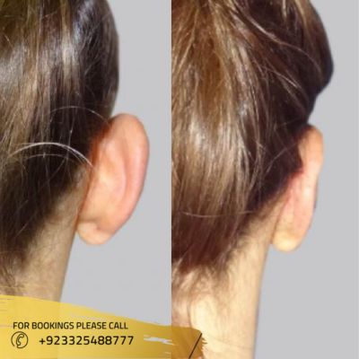 results of ear reshaping in Islamabad