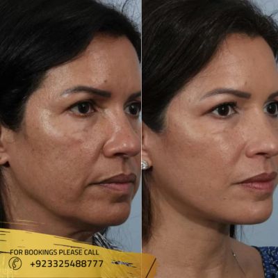 results of facelift treatment in Islamabad