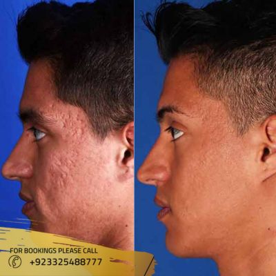 results of laser scar removal in Islamabad