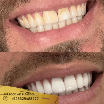 results of laser teeth whitening in Islamabad