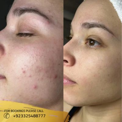 results of microdermabrasion treatment in Islamabad