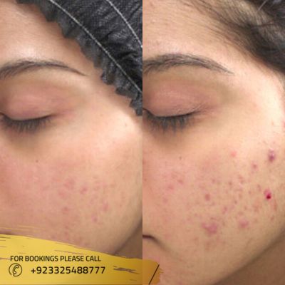results of microneedling treatment in Islamabad