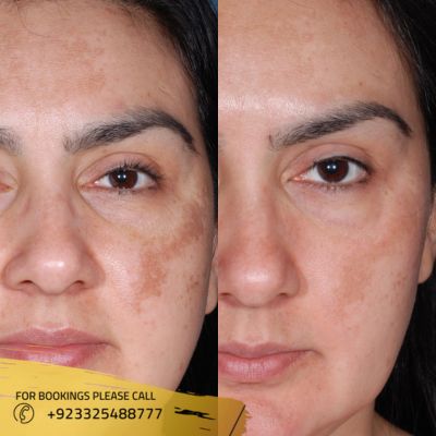 results of pigmentation treatment in Islamabad