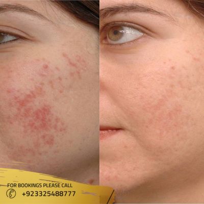 results of rashes treatment in Islamabad