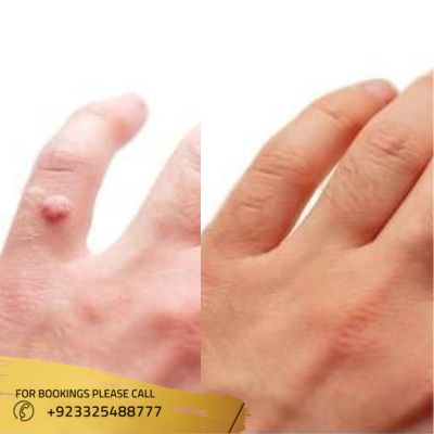 results of warts removal in Islamabad
