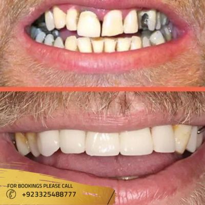 Before after of Root canal treatment in Islamabad