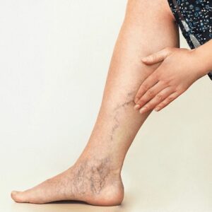 Can spider veins be cured permanently in Islamabad?