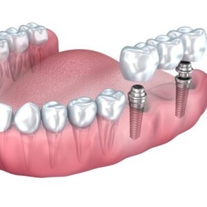 Do implants in Islamabad get cavities?