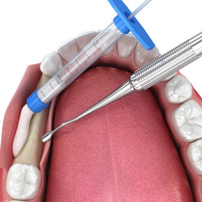 Gum Grafting treatment