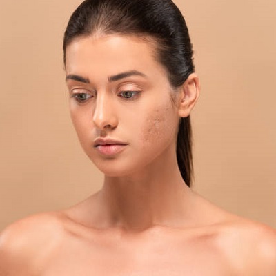 How Do You Get Rid of Rolling Acne Scars in Islamabad?
