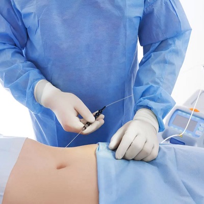 What is smart liposuction?