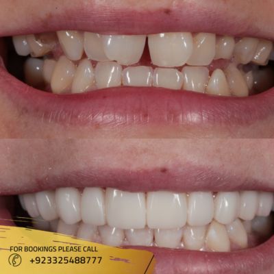 Before after of Overlapping teeth treatment in Islamabad