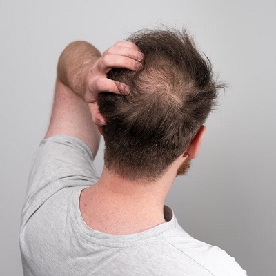 Can Dandruff Cause Hair Loss? An In-Depth Look