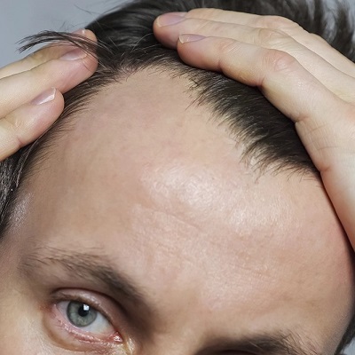 Can Energy Drinks Cause Hair Loss?