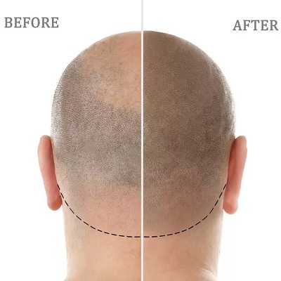 How painful is scalp micro pigmentation?