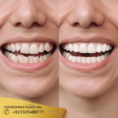 Images of Overlapping teeth treatment in Islamabad