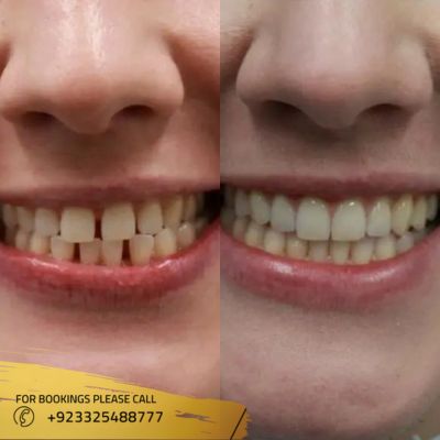 Overlapping teeth treatment in Islamabad