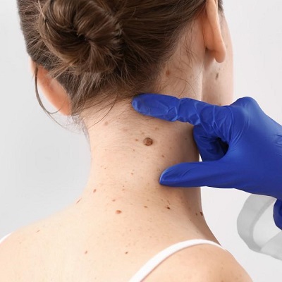 What Is the Best Treatment for Skin Tag Removal in Islamabad?