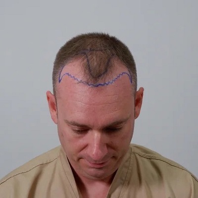 What happens to original hair after hair transplant?