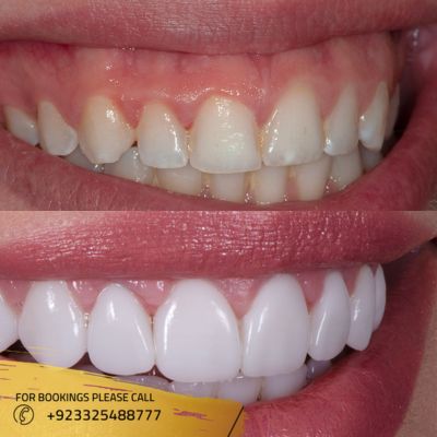 Gum Grafting treatment in Islamabad