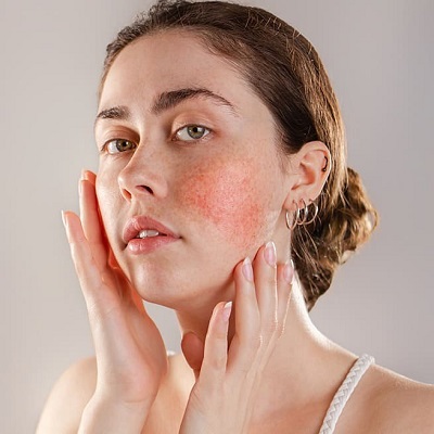 Can Rosacea Be Cured Permanently?