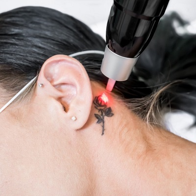 Does Laser Tattoo Removal Cause Scars?