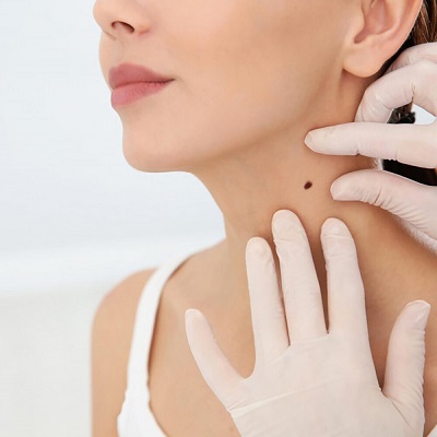 Is It Good to Remove a Mole by Laser?