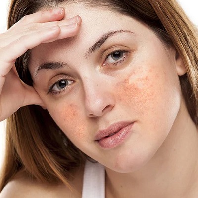 What is the root cause of melasma?