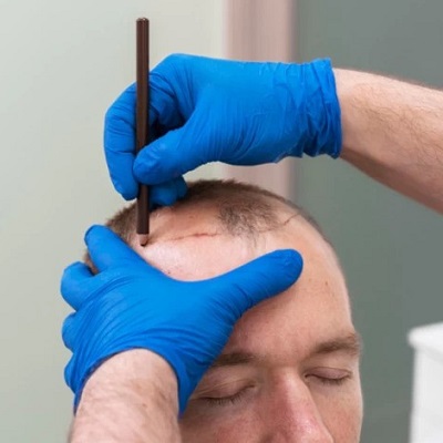 When Can You Get a Haircut After Hair Transplant Surgery?