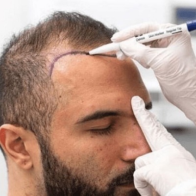 8 Tips for A Speedy Recovery After A Hair Transplant