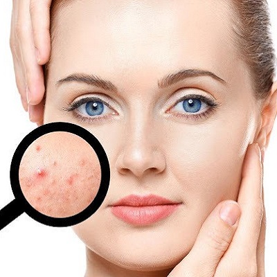 How to Clear Stubborn Acne in Islamabad?