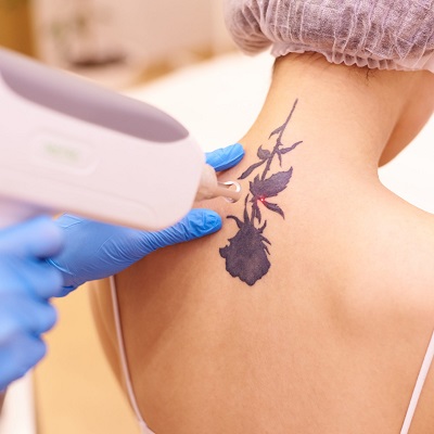 Which colours can be treated with laser tattoo removal?