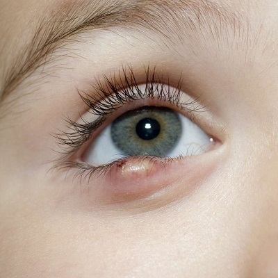 Will My Eyelids Look Normal After Bump Removal?