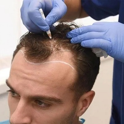 Ideal Diet Before A Hair Transplant in Islamabad