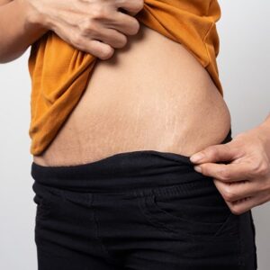 Stretch Marks Removal Cost in Islamabad