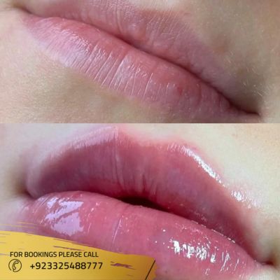 Before after of dermal fillers in islamabad