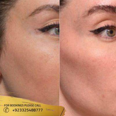 images of dermal fillers in islamabad