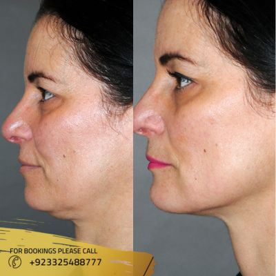 results of dermal fillers in islamabad